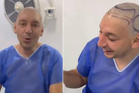 “Estoy contento y feliz”: Rodrigo Gallina se sometió a un cirugía de injerto capilar  