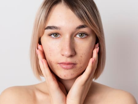 El remedio casero para eliminar acné, espinillas y grasa en la piel